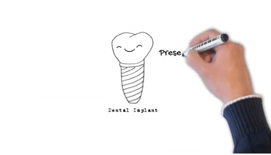 A hand with a black marker draws a dental implant on a whiteboard