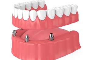 illustration of all on 4 dental implants, with 4 implants on the gumline and an entire row of teeth being placed on the implants