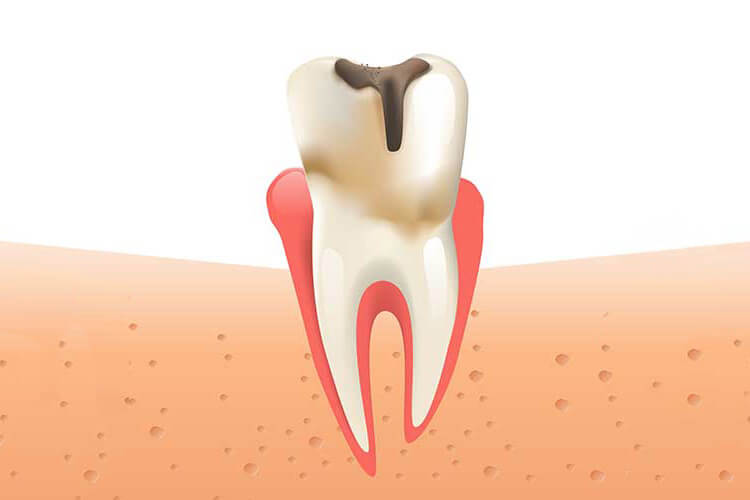 Illustration of a tooth with a cavity in it