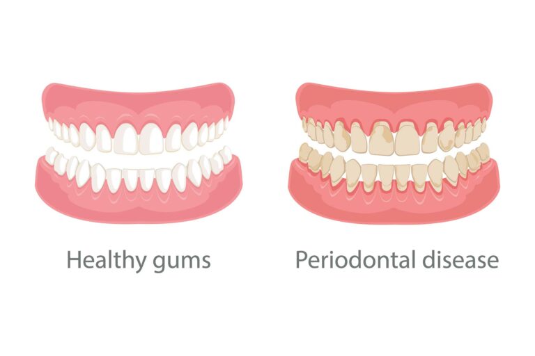 illustration of health gums vs gums with periodontal disease