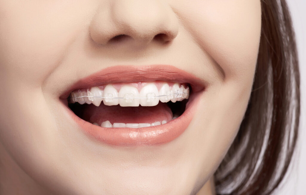 Woman smiling with invisible braces.
