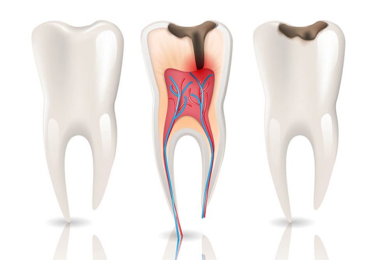 Illustration of three white teeth showing various stages of tooth decay