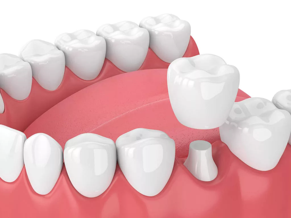 Illustration of a dental crown being added to a row of teeth