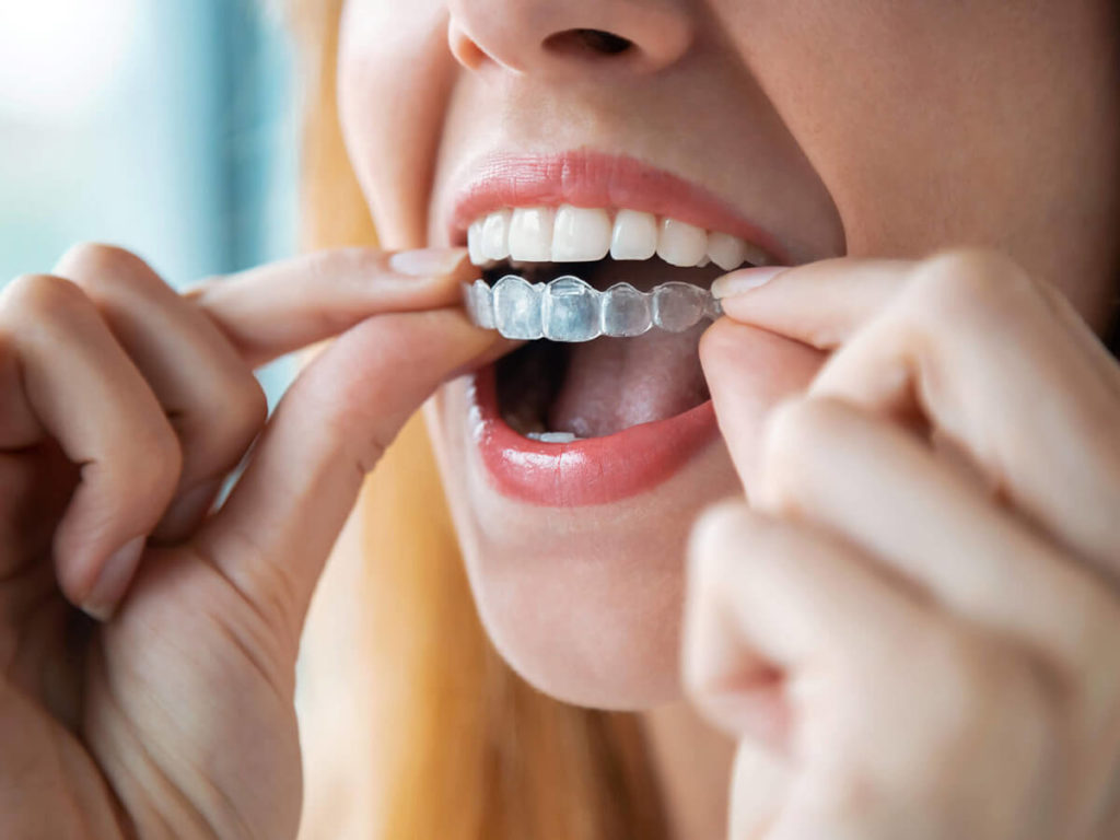 A woman puts a top tray of Invisalign clear aligners on her teeth