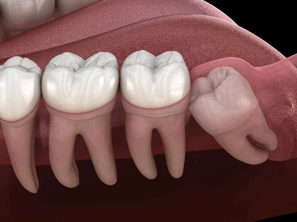 Wisdom tooth removal in Jacksonville, FL at Normandy Lake Dentistry.