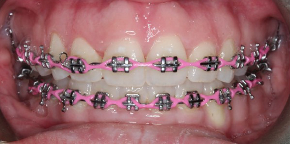 After Metal Braces